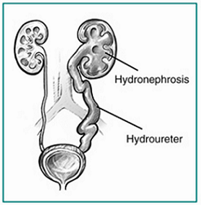 Diagram shows hydronephrosis, or a buildup of urine in the kidneys